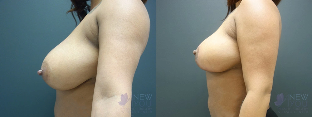 Real Patient Results by Dr. Shah of A New You Plastic Surgery & Medical Spa in Chicago, IL