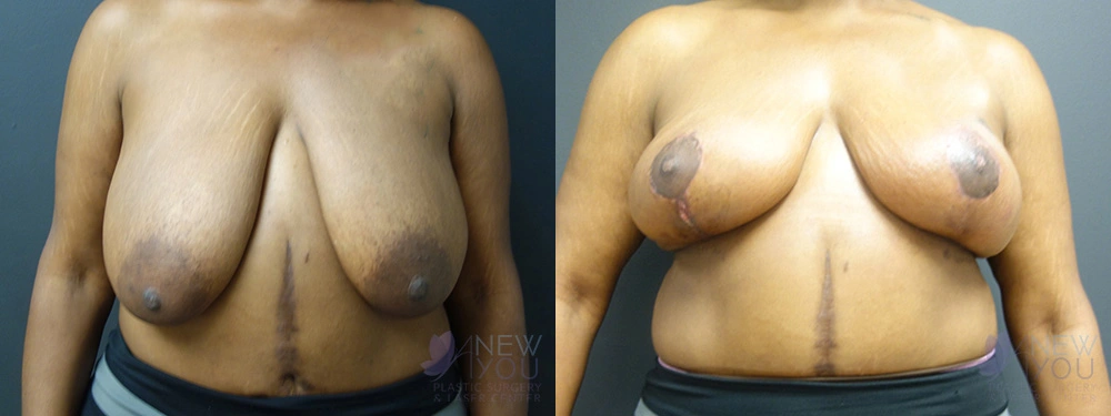 Real Patient Results by Dr. Shah of A New You Plastic Surgery & Medical Spa in Chicago, IL