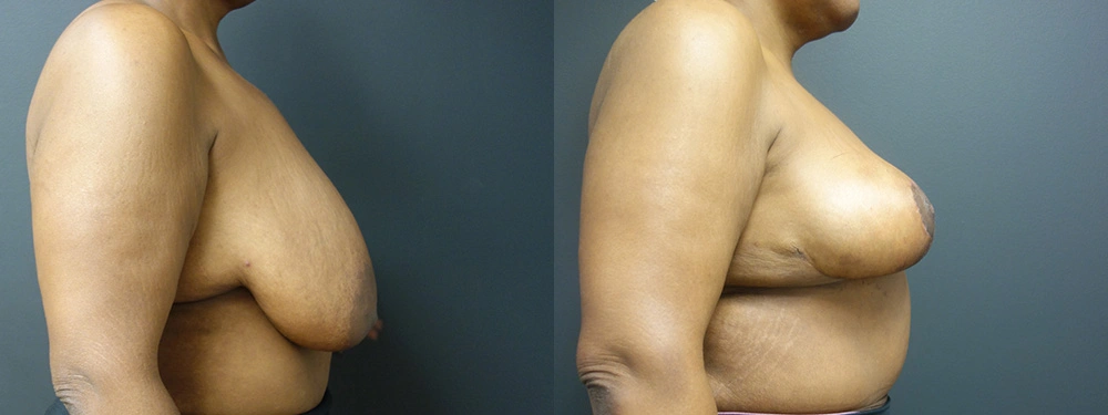 Real Patient Results by Dr. Shah of A New You Plastic Surgery & Medical Spa in Chicago, IL