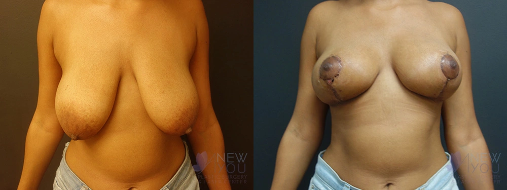 Real Patient Results by Dr. Shah of A New You Plastic Surgery & Medical Spa in Chicago, IL