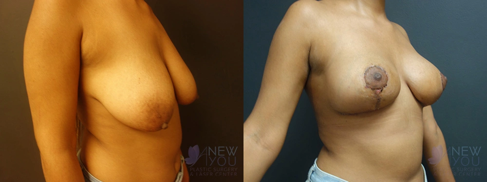 Real Patient Results by Dr. Shah of A New You Plastic Surgery & Medical Spa in Chicago, IL