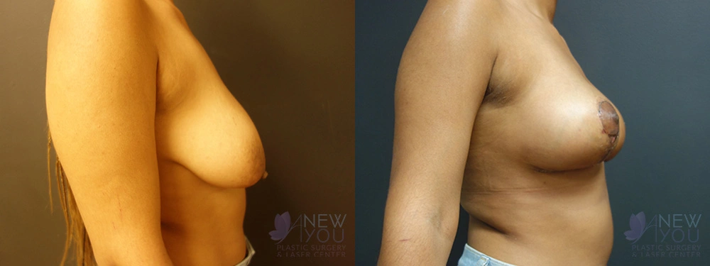 Real Patient Results by Dr. Shah of A New You Plastic Surgery & Medical Spa in Chicago, IL