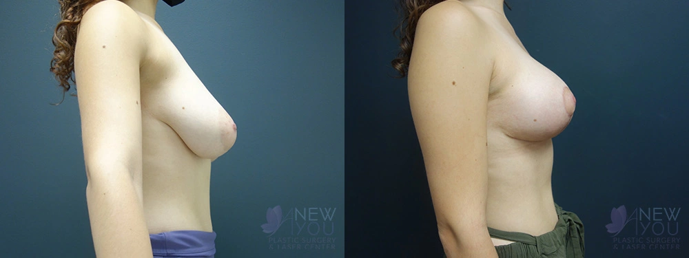 Real Patient Results by Dr. Shah of A New You Plastic Surgery & Medical Spa in Chicago, IL