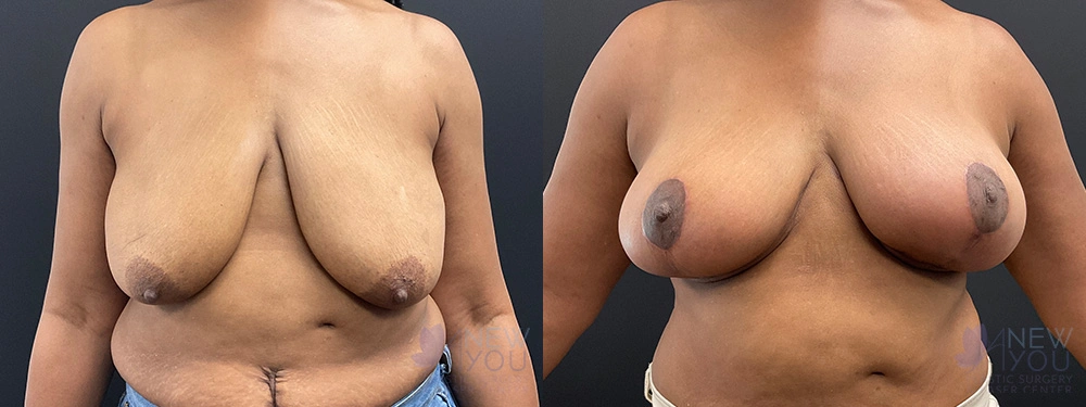 Real Patient Results by Dr. Shah of A New You Plastic Surgery & Medical Spa in Chicago, IL