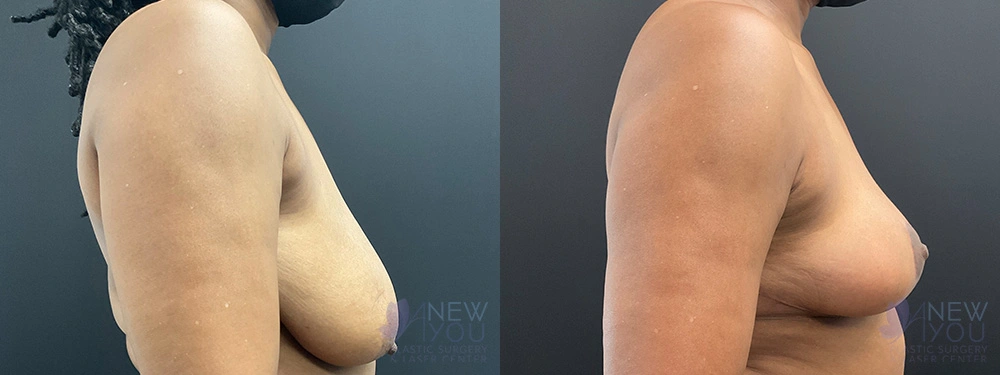 Real Patient Results by Dr. Shah of A New You Plastic Surgery & Medical Spa in Chicago, IL
