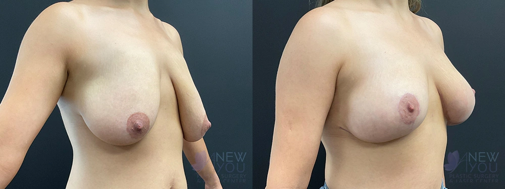 Real Patient Results by Dr. Shah of A New You Plastic Surgery & Medical Spa in Chicago, IL