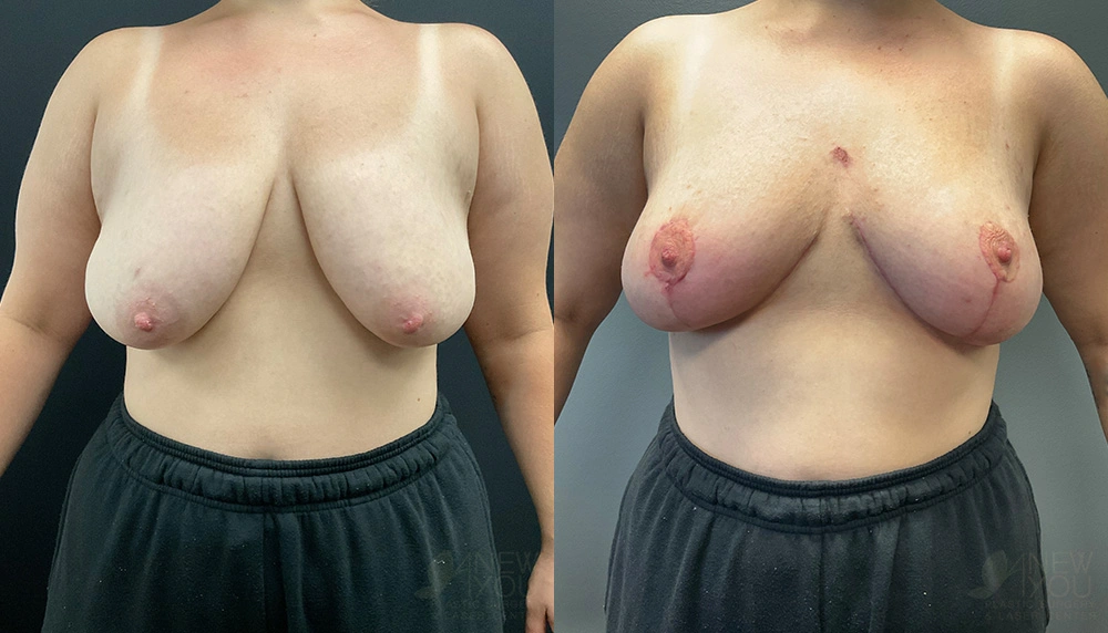 Real Patient Results by Dr. Shah of A New You Plastic Surgery & Medical Spa in Chicago, IL