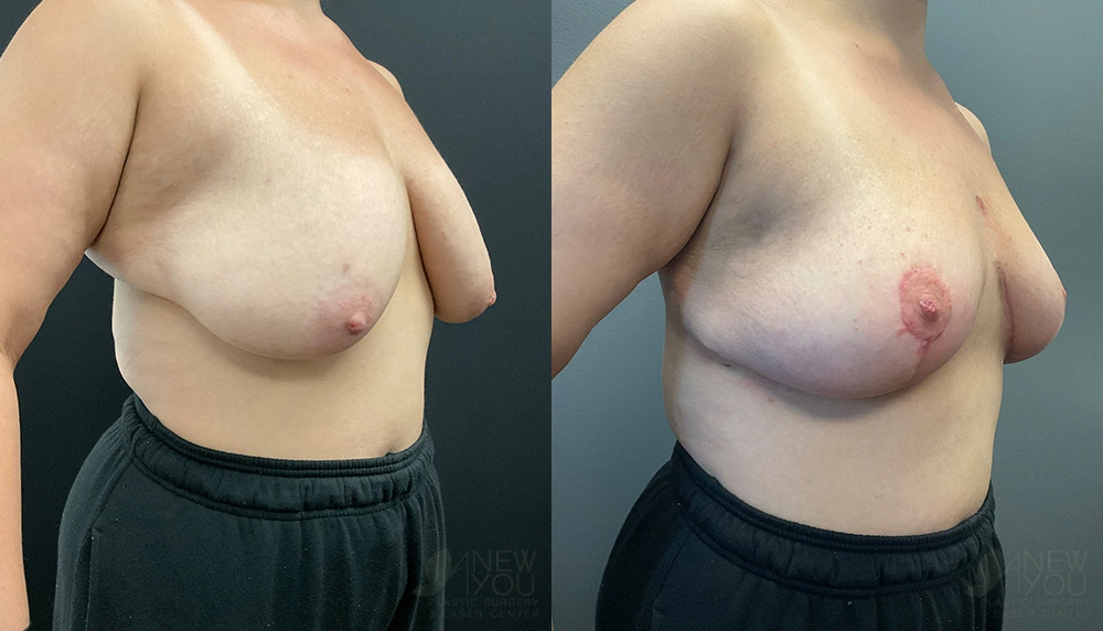 Real Patient Results by Dr. Shah of A New You Plastic Surgery & Medical Spa in Chicago, IL