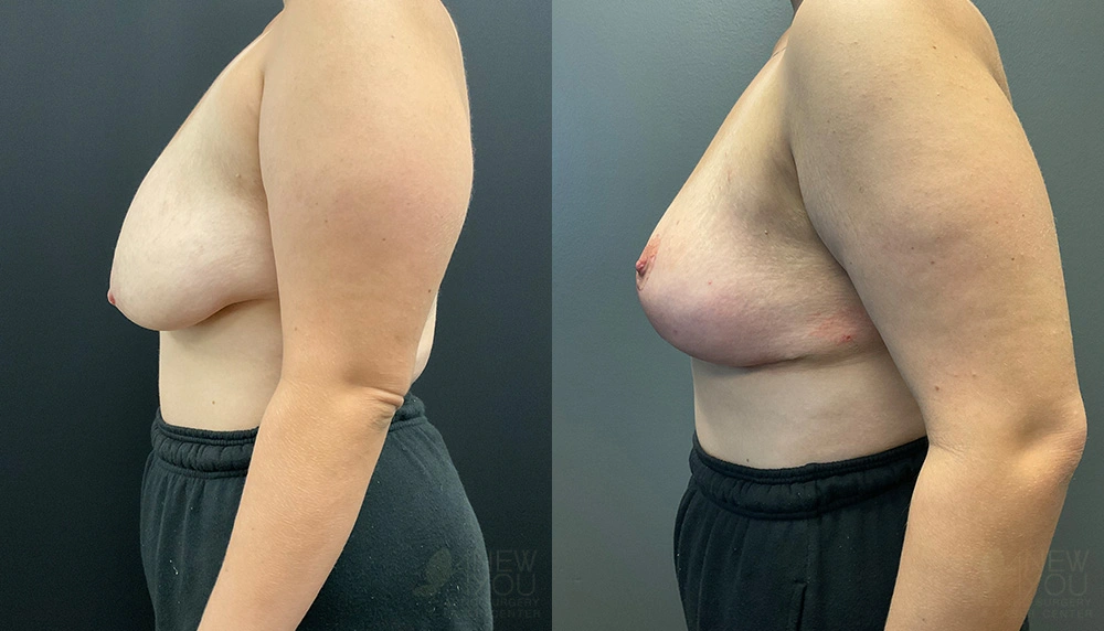 Real Patient Results by Dr. Shah of A New You Plastic Surgery & Medical Spa in Chicago, IL