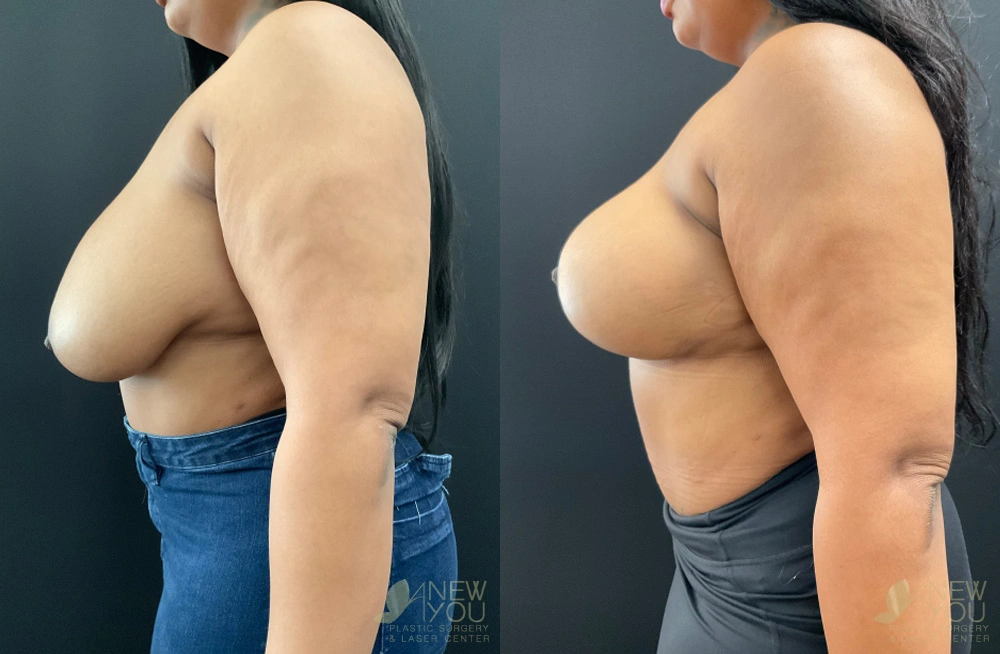 Real Patient Results by Dr. Shah of A New You Plastic Surgery & Medical Spa in Chicago, IL