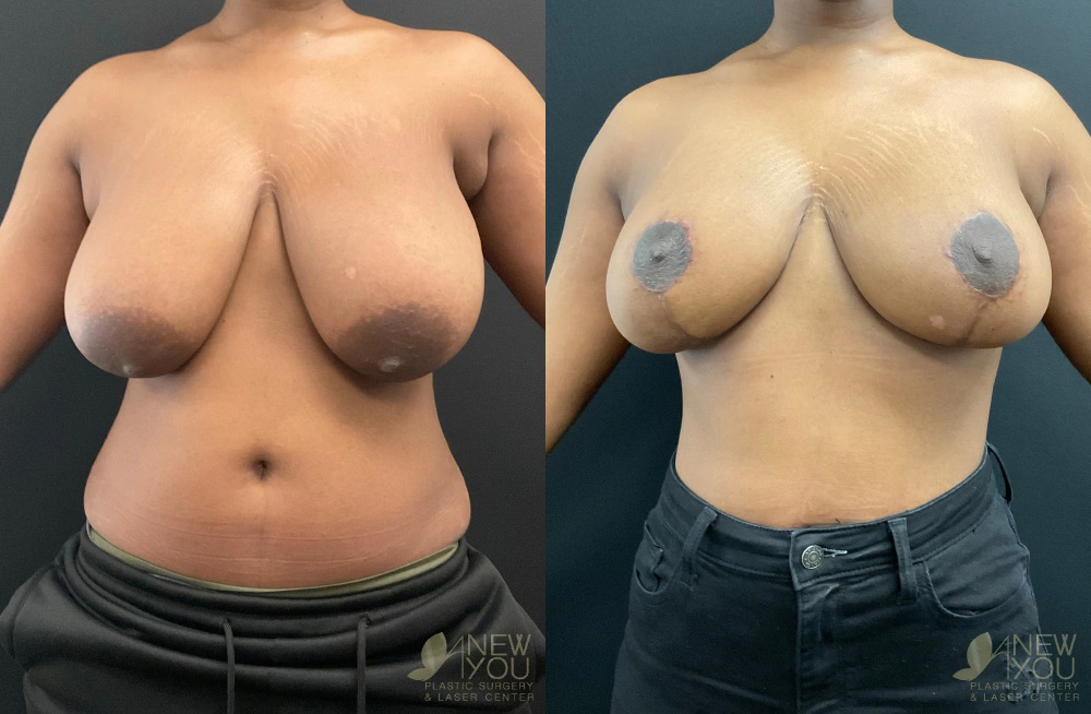 Real Patient Results by Dr. Shah of A New You Plastic Surgery & Medical Spa in Chicago, IL