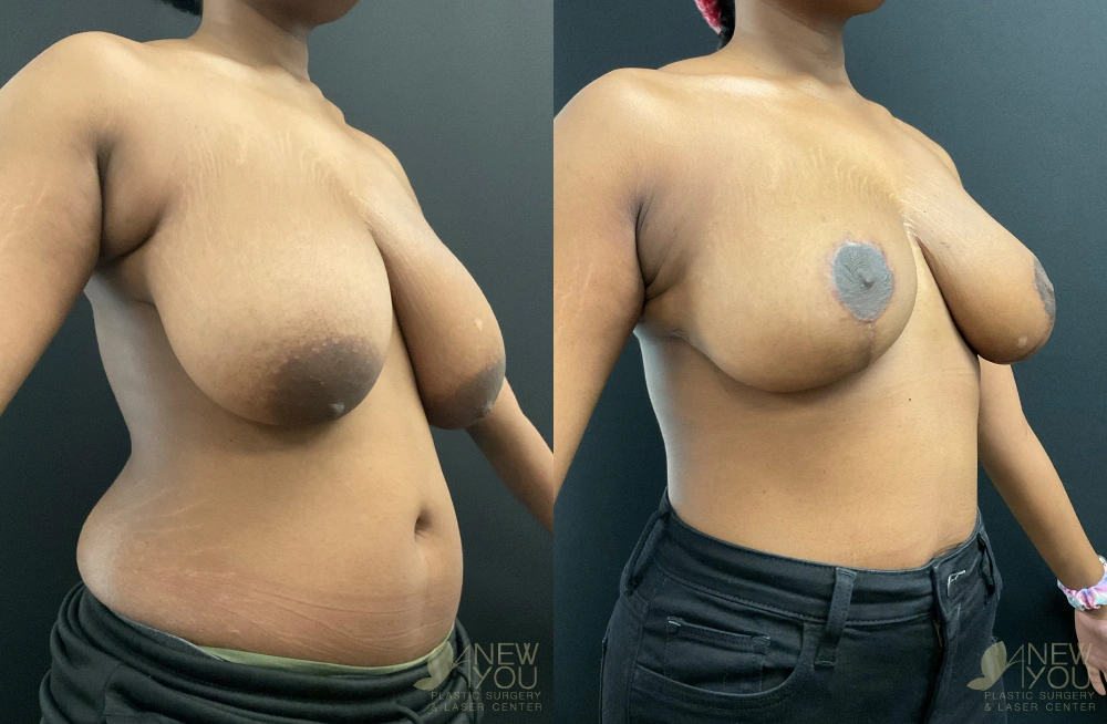 Real Patient Results by Dr. Shah of A New You Plastic Surgery & Medical Spa in Chicago, IL