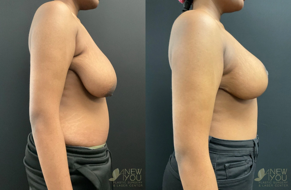 Real Patient Results by Dr. Shah of A New You Plastic Surgery & Medical Spa in Chicago, IL