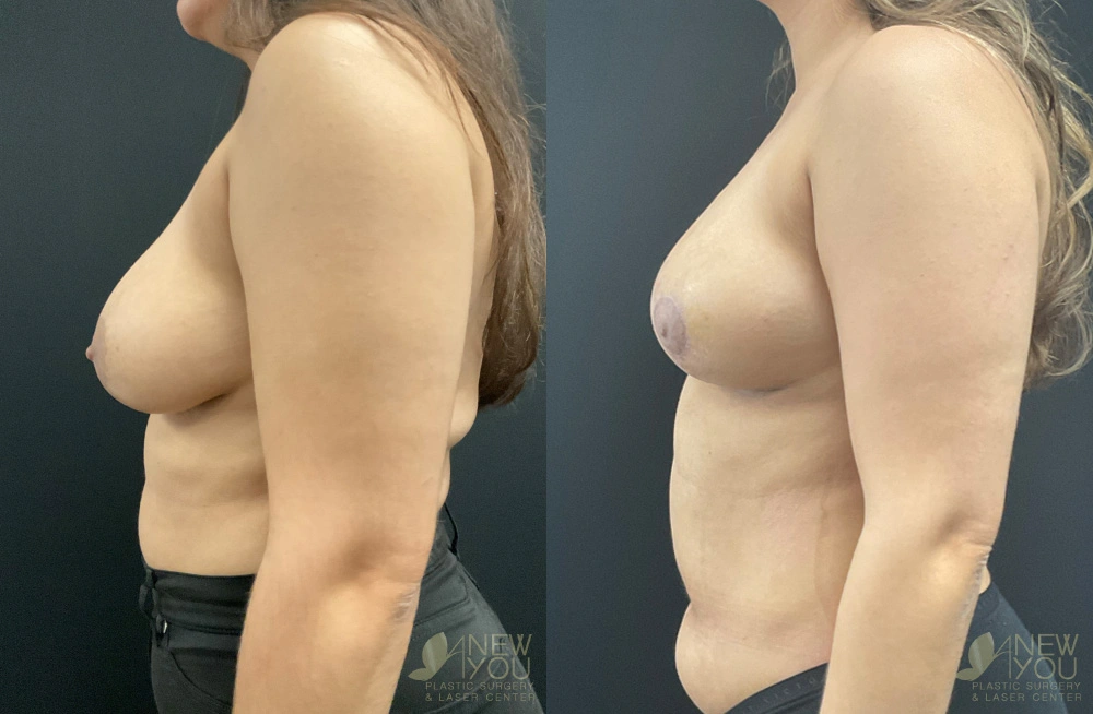 Real Patient Results by Dr. Shah of A New You Plastic Surgery & Medical Spa in Chicago, IL