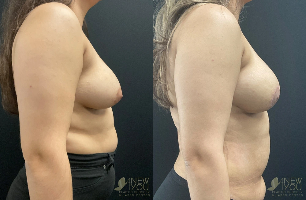 Real Patient Results by Dr. Shah of A New You Plastic Surgery & Medical Spa in Chicago, IL