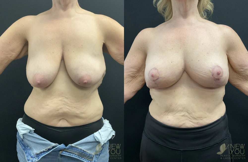 Real Patient Results by Dr. Shah of A New You Plastic Surgery & Medical Spa in Chicago, IL