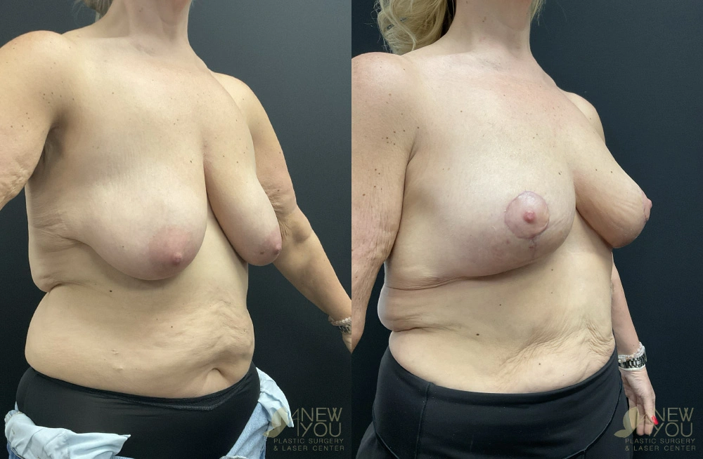 Real Patient Results by Dr. Shah of A New You Plastic Surgery & Medical Spa in Chicago, IL