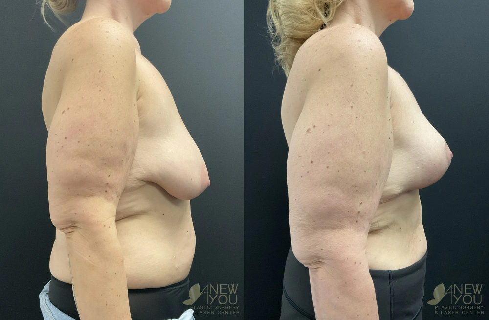 Real Patient Results by Dr. Shah of A New You Plastic Surgery & Medical Spa in Chicago, IL