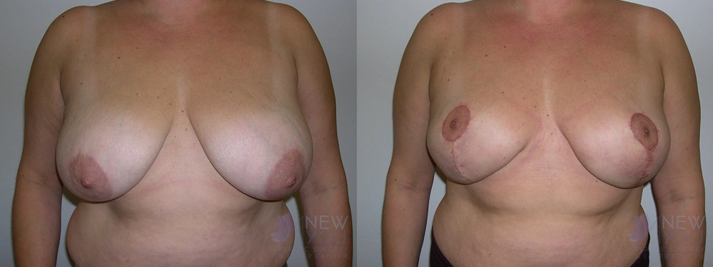 Real Patient Results by Dr. Shah of A New You Plastic Surgery & Medical Spa in Chicago, IL
