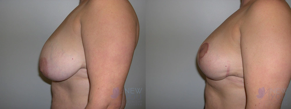 Real Patient Results by Dr. Shah of A New You Plastic Surgery & Medical Spa in Chicago, IL
