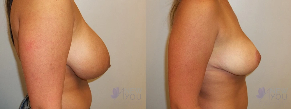 Real Patient Results by Dr. Shah of A New You Plastic Surgery & Medical Spa in Chicago, IL