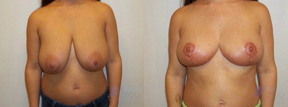 Real Patient Results by Dr. Shah of A New You Plastic Surgery & Medical Spa in Chicago, IL