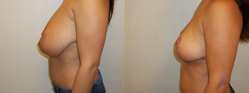 Real Patient Results by Dr. Shah of A New You Plastic Surgery & Medical Spa in Chicago, IL