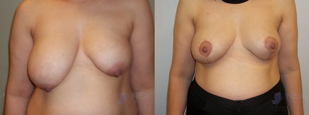 Real Patient Results by Dr. Shah of A New You Plastic Surgery & Medical Spa in Chicago, IL