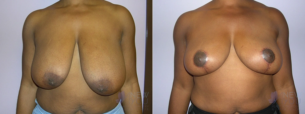 Real Patient Results by Dr. Shah of A New You Plastic Surgery & Medical Spa in Chicago, IL