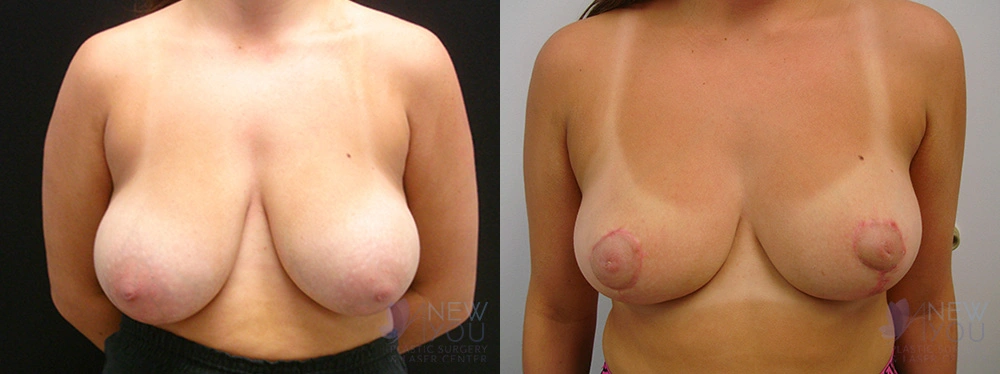 Real Patient Results by Dr. Shah of A New You Plastic Surgery & Medical Spa in Chicago, IL