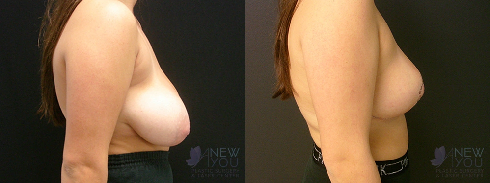 Real Patient Results by Dr. Shah of A New You Plastic Surgery & Medical Spa in Chicago, IL