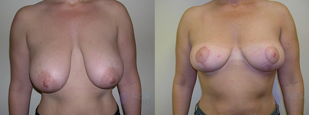 Real Patient Results by Dr. Shah of A New You Plastic Surgery & Medical Spa in Chicago, IL