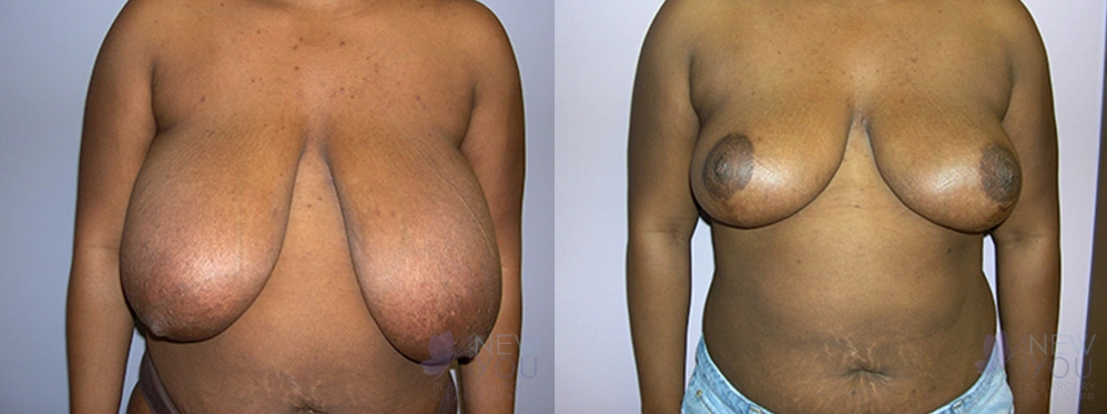 Real Patient Results by Dr. Shah of A New You Plastic Surgery & Medical Spa in Chicago, IL