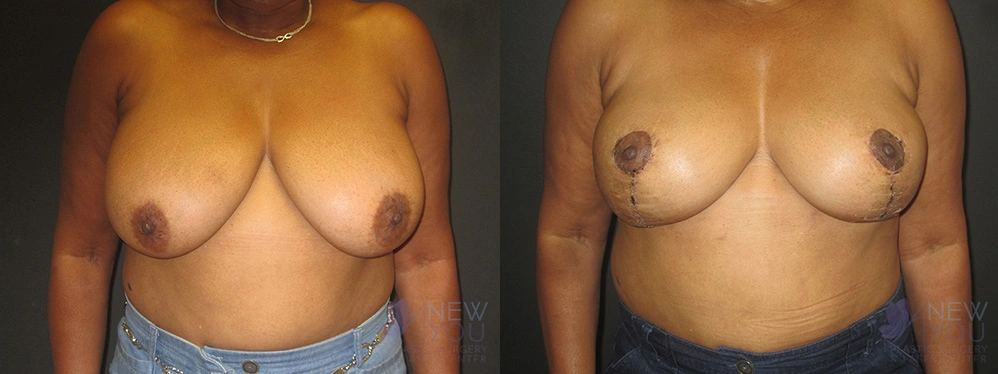 Real Patient Results by Dr. Shah of A New You Plastic Surgery & Medical Spa in Chicago, IL