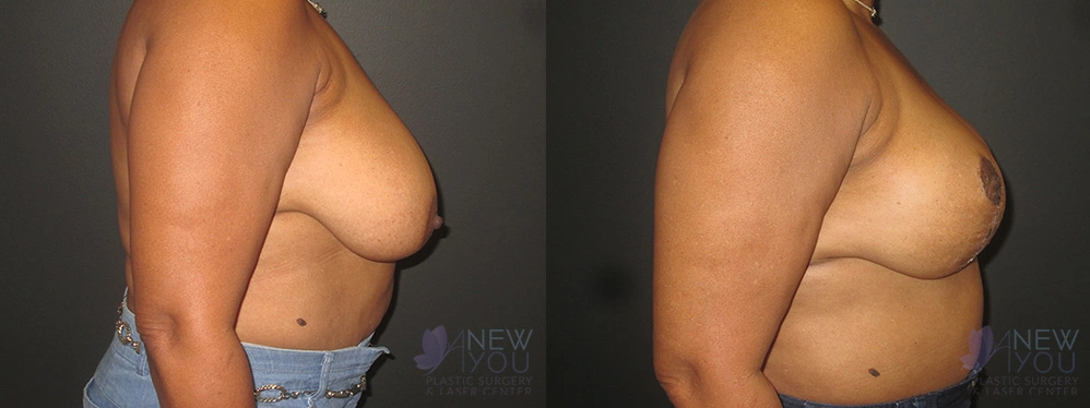 Real Patient Results by Dr. Shah of A New You Plastic Surgery & Medical Spa in Chicago, IL