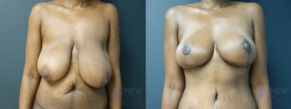 Real Patient Results by Dr. Shah of A New You Plastic Surgery & Medical Spa in Chicago, IL