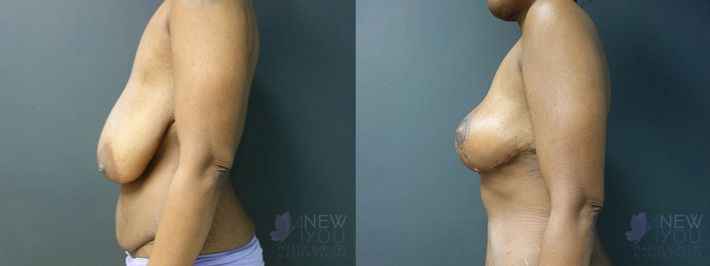 Real Patient Results by Dr. Shah of A New You Plastic Surgery & Medical Spa in Chicago, IL