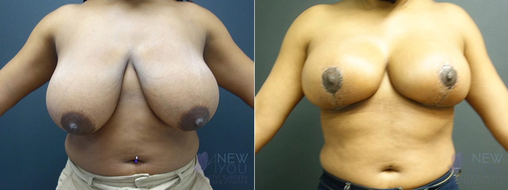 Real Patient Results by Dr. Shah of A New You Plastic Surgery & Medical Spa in Chicago, IL