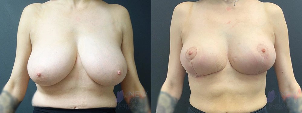 Real Patient Results by Dr. Shah of A New You Plastic Surgery & Medical Spa in Chicago, IL