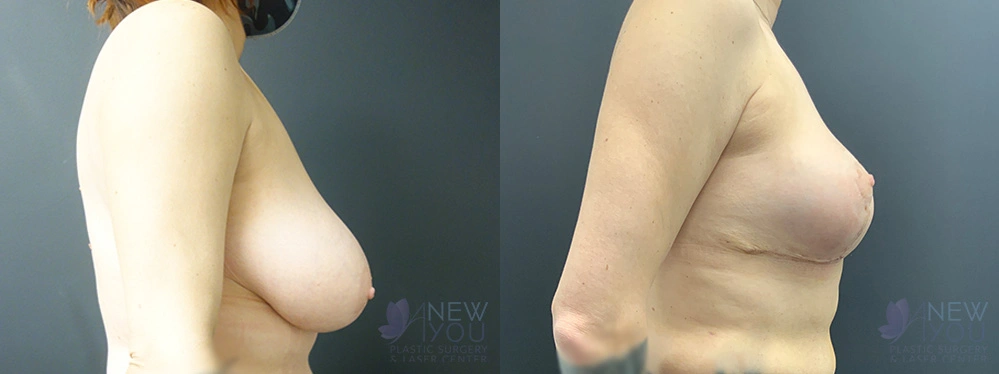 Real Patient Results by Dr. Shah of A New You Plastic Surgery & Medical Spa in Chicago, IL