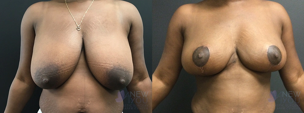 Real Patient Results by Dr. Shah of A New You Plastic Surgery & Medical Spa in Chicago, IL
