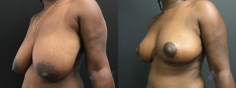 Real Patient Results by Dr. Shah of A New You Plastic Surgery & Medical Spa in Chicago, IL