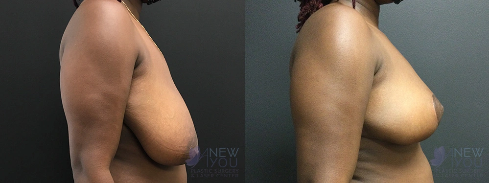 Real Patient Results by Dr. Shah of A New You Plastic Surgery & Medical Spa in Chicago, IL