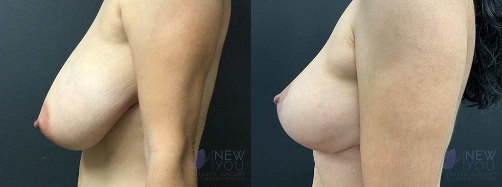 Real Patient Results by Dr. Shah of A New You Plastic Surgery & Medical Spa in Chicago, IL