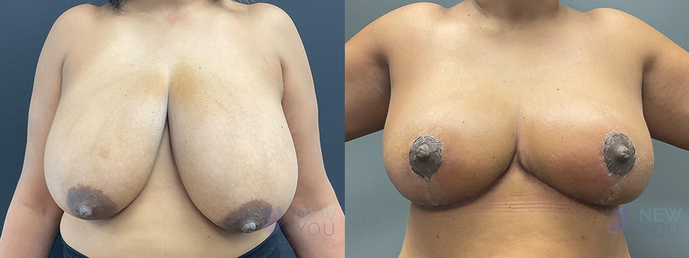 Real Patient Results by Dr. Shah of A New You Plastic Surgery & Medical Spa in Chicago, IL
