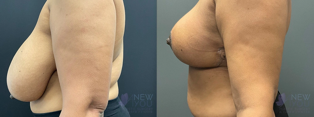 Real Patient Results by Dr. Shah of A New You Plastic Surgery & Medical Spa in Chicago, IL