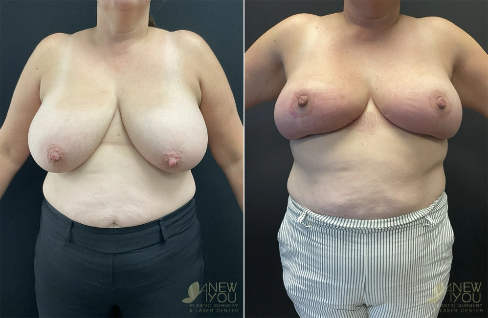 Real Patient Results by Dr. Shah of A New You Plastic Surgery & Medical Spa in Chicago, IL