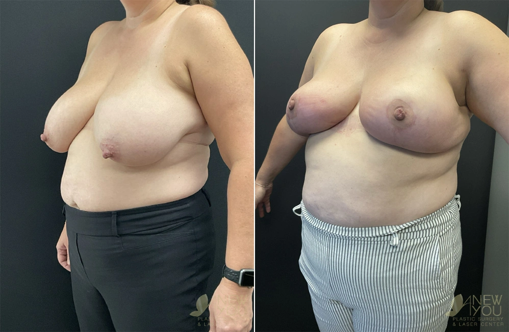 Real Patient Results by Dr. Shah of A New You Plastic Surgery & Medical Spa in Chicago, IL