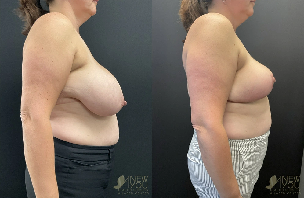 Real Patient Results by Dr. Shah of A New You Plastic Surgery & Medical Spa in Chicago, IL