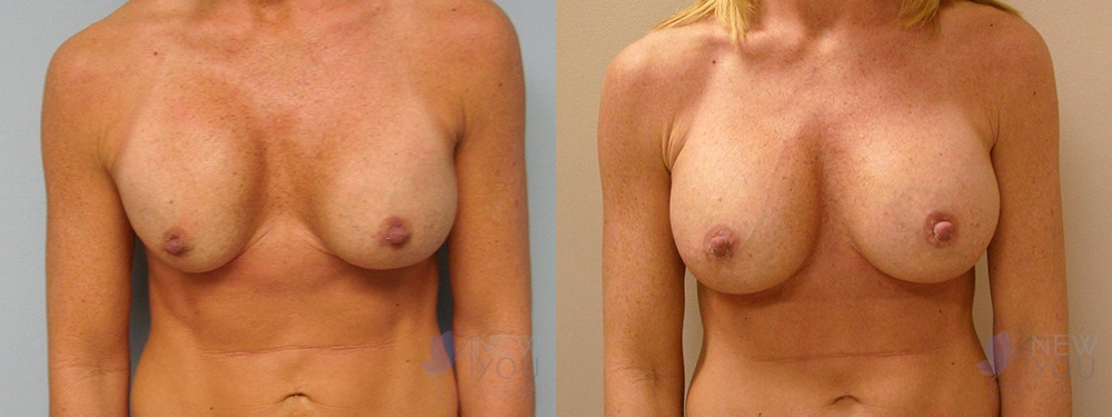 Real Patient Results by Dr. Shah of A New You Plastic Surgery & Medical Spa in Chicago, IL